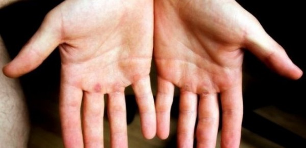 Nasır Nasıl Geçer? Nasır Neden Olur?